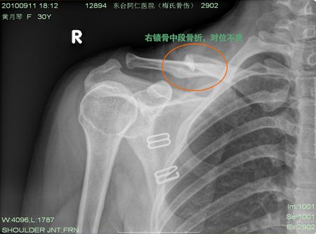 右锁骨中端骨折,手术后3个月恢复情况
