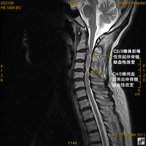 何贤林颈椎磁共振(mri)片