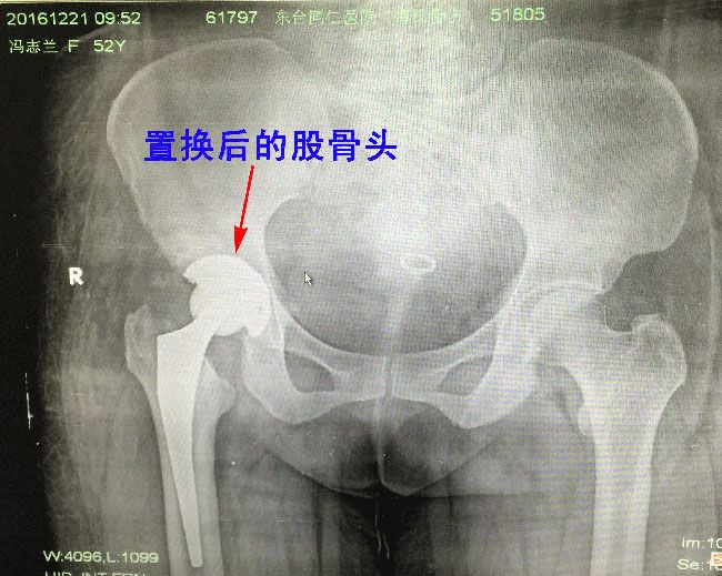 股骨头置换手术前后对比